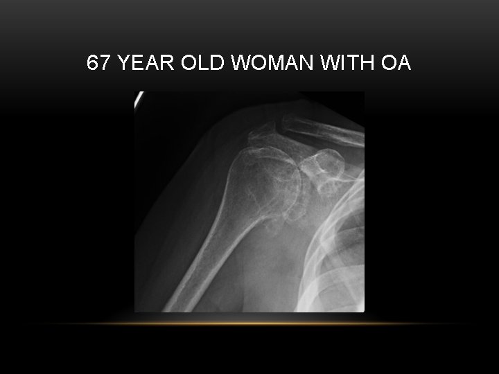 67 YEAR OLD WOMAN WITH OA 