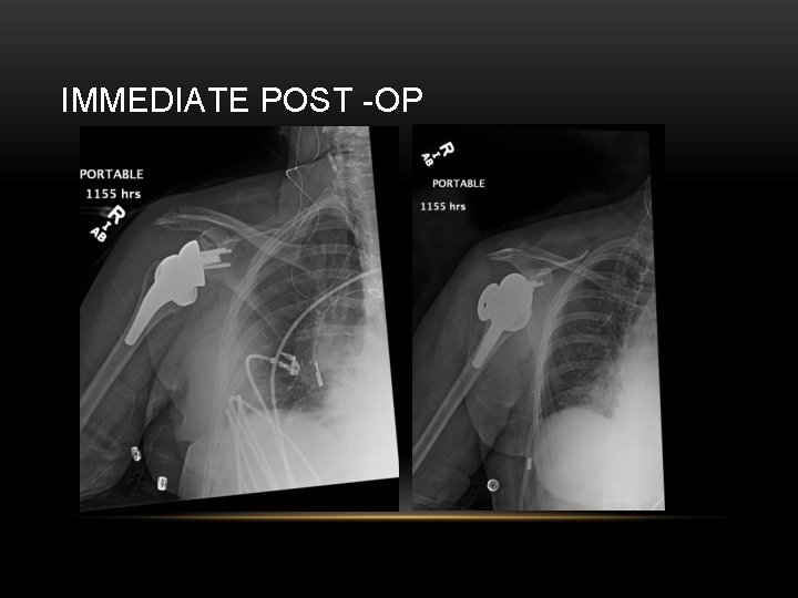 IMMEDIATE POST -OP 