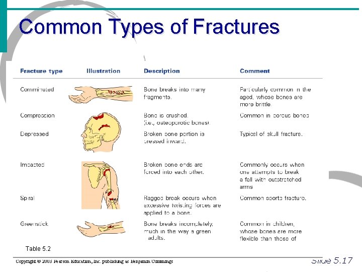 Common Types of Fractures Table 5. 2 Copyright © 2003 Pearson Education, Inc. publishing