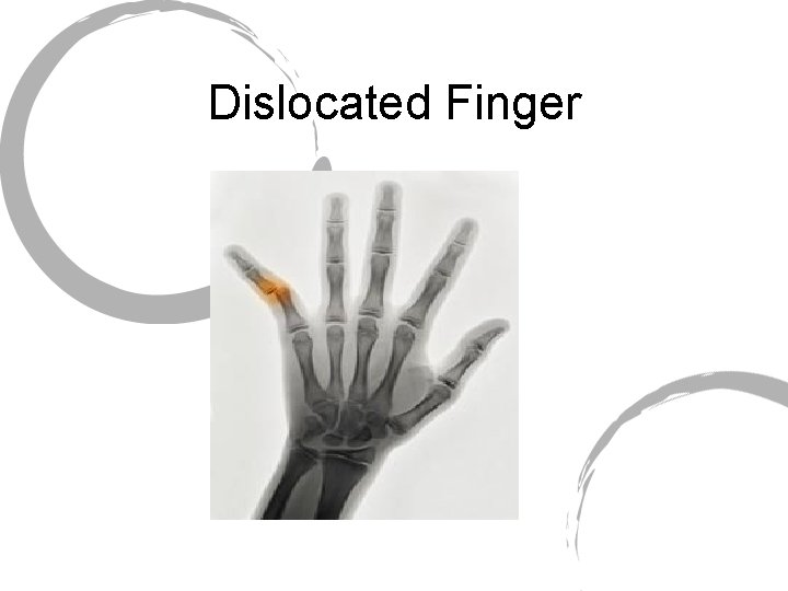 Dislocated Finger 