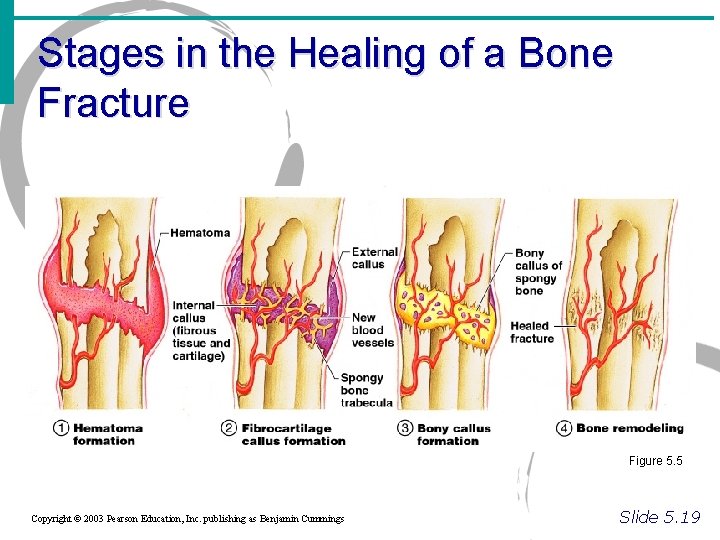 Stages in the Healing of a Bone Fracture Figure 5. 5 Copyright © 2003