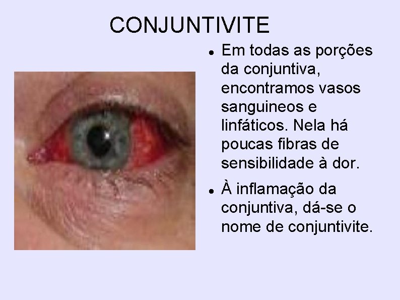 CONJUNTIVITE Em todas as porções da conjuntiva, encontramos vasos sanguineos e linfáticos. Nela há