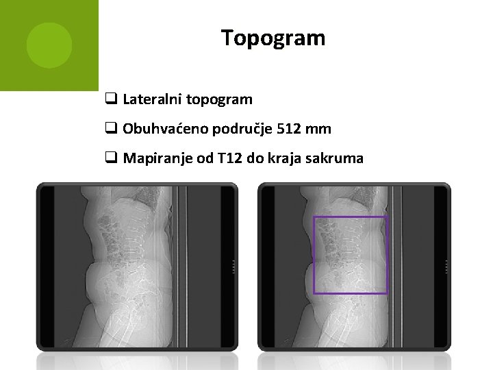 Topogram q Lateralni topogram q Obuhvaćeno područje 512 mm q Mapiranje od T 12