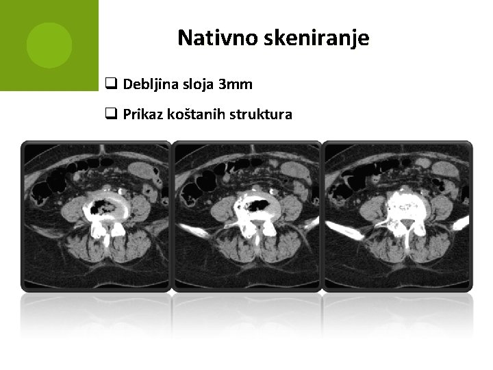 Nativno skeniranje q Debljina sloja 3 mm q Prikaz koštanih struktura 