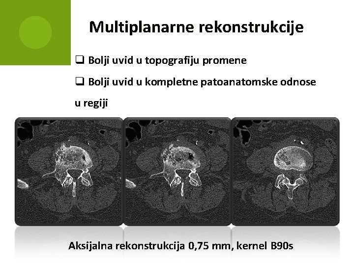 Multiplanarne rekonstrukcije q Bolji uvid u topografiju promene q Bolji uvid u kompletne patoanatomske