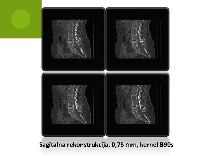 Sagitalna rekonstrukcija, 0, 75 mm, kernel B 90 s 