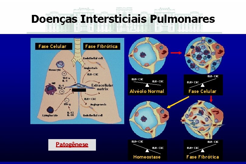Doenças Intersticiais Pulmonares Fase Celular Fase Fibrótica Endothelial cell Angiostasis Monocyte + MØ ELR-