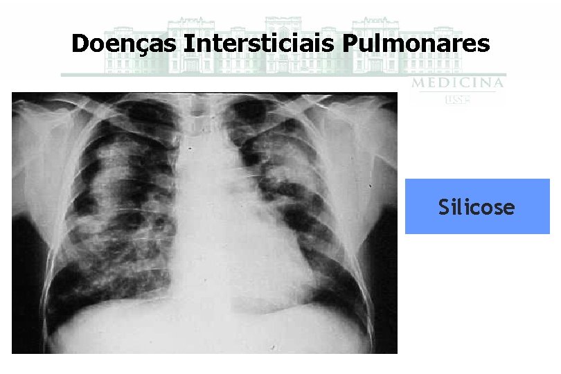 Doenças Intersticiais Pulmonares Silicose 