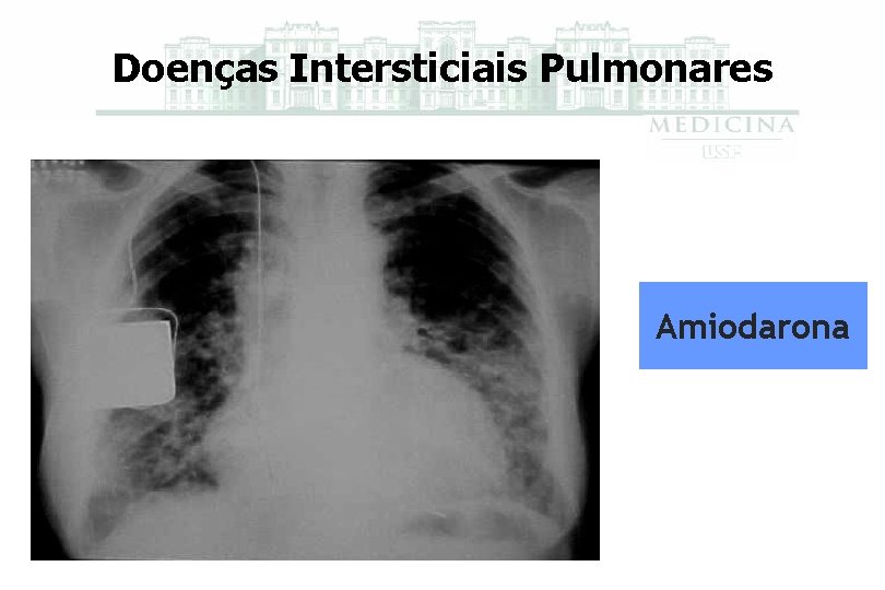 Doenças Intersticiais Pulmonares Amiodarona 