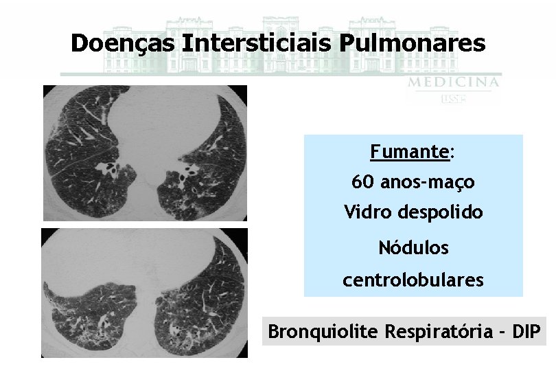 Doenças Intersticiais Pulmonares Fumante: 60 anos-maço Vidro despolido Nódulos centrolobulares Bronquiolite Respiratória - DIP