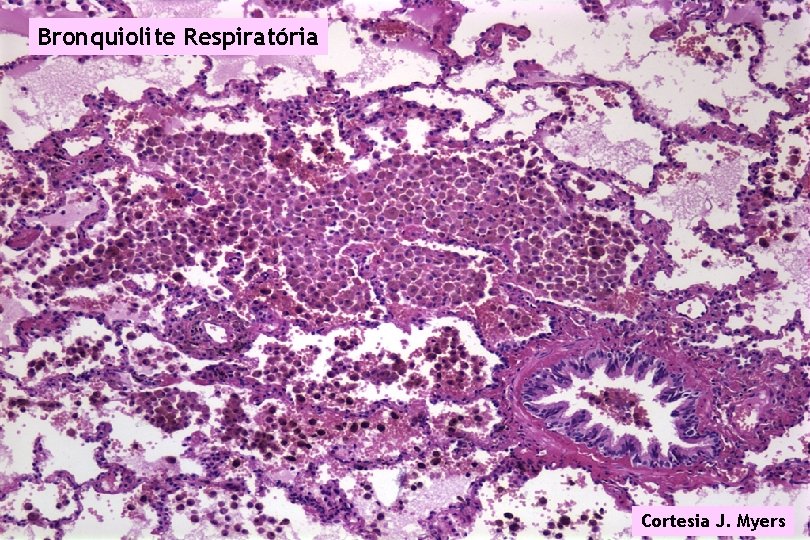 Bronquiolite Respiratória Cortesia J. Myers 