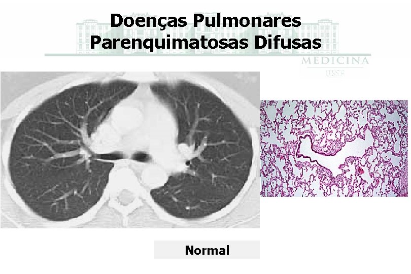 Doenças Pulmonares Parenquimatosas Difusas Normal 