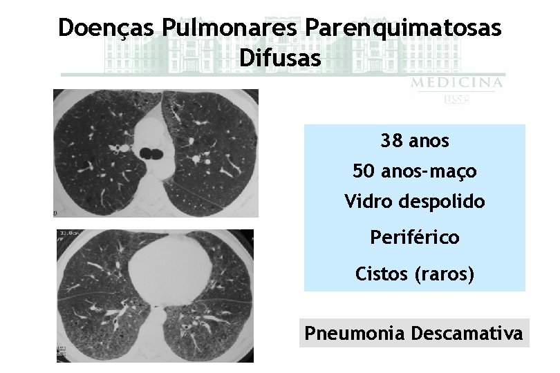 Doenças Pulmonares Parenquimatosas Difusas 38 anos 50 anos-maço Vidro despolido Periférico Cistos (raros) Pneumonia