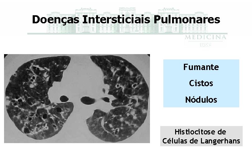 Doenças Intersticiais Pulmonares Fumante Cistos Nódulos Histiocitose de Células de Langerhans 