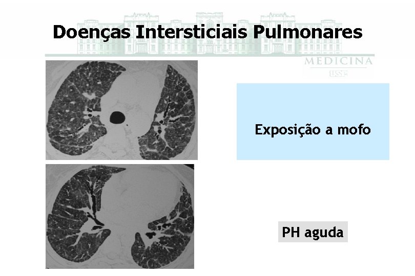 Doenças Intersticiais Pulmonares Exposição a mofo PH aguda 