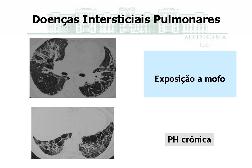 Doenças Intersticiais Pulmonares Exposição a mofo PH crônica 