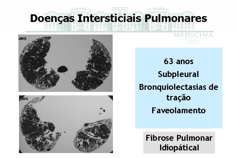 Doenças Intersticiais Pulmonares 63 anos Subpleural Bronquiolectasias de tração Faveolamento Fibrose Pulmonar Idiopática. I