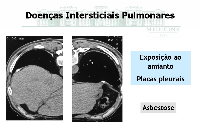 Doenças Intersticiais Pulmonares Exposição ao amianto Placas pleurais Asbestose 