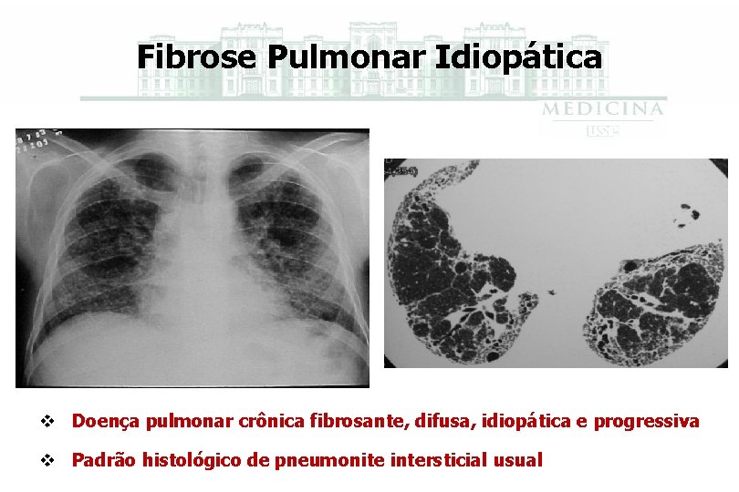 Fibrose Pulmonar Idiopática v Doença pulmonar crônica fibrosante, difusa, idiopática e progressiva v Padrão