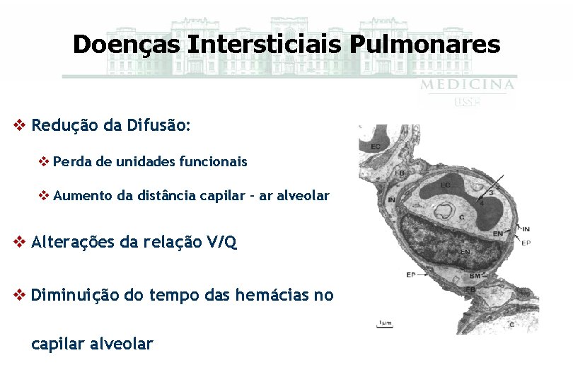 Doenças Intersticiais Pulmonares v Redução da Difusão: v Perda de unidades funcionais v Aumento