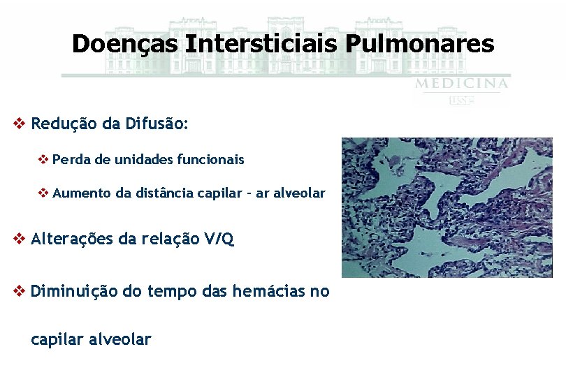 Doenças Intersticiais Pulmonares v Redução da Difusão: v Perda de unidades funcionais v Aumento