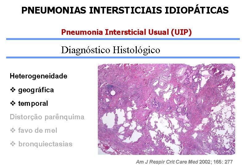 PNEUMONIAS INTERSTICIAIS IDIOPÁTICAS Pneumonia Intersticial Usual (UIP) Diagnóstico Histológico Heterogeneidade v geográfica v temporal
