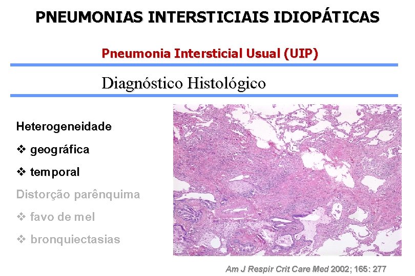 PNEUMONIAS INTERSTICIAIS IDIOPÁTICAS Pneumonia Intersticial Usual (UIP) Diagnóstico Histológico Heterogeneidade v geográfica v temporal