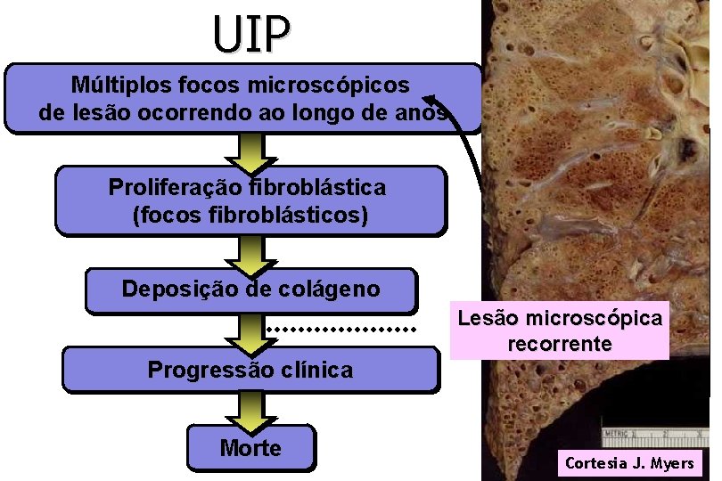 UIP Múltiplos focos microscópicos de lesão ocorrendo ao longo de anos Proliferação fibroblástica (focos