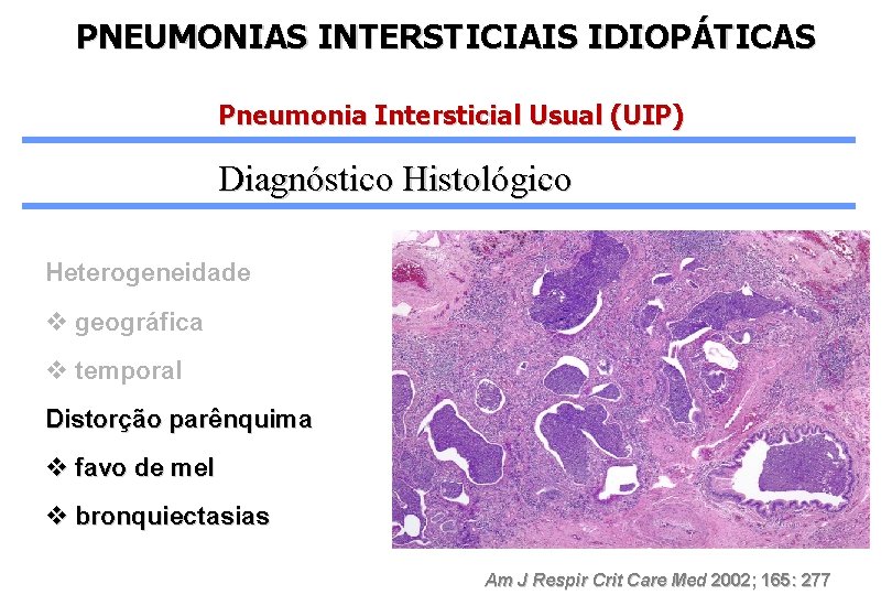 PNEUMONIAS INTERSTICIAIS IDIOPÁTICAS Pneumonia Intersticial Usual (UIP) Diagnóstico Histológico Heterogeneidade v geográfica v temporal