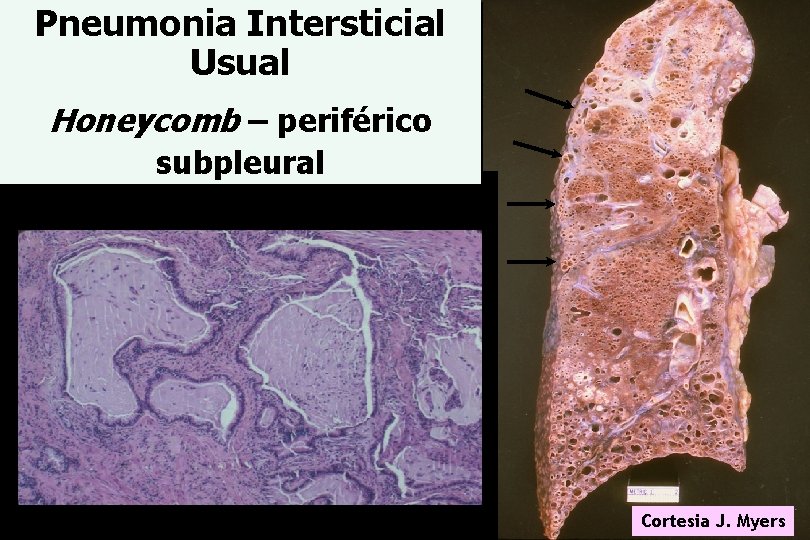 Pneumonia Intersticial Usual Honeycomb – periférico subpleural Cortesia J. Myers 