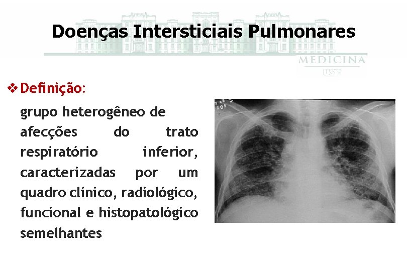 Doenças Intersticiais Pulmonares v Definição: Definição grupo heterogêneo de afecções do trato respiratório inferior,