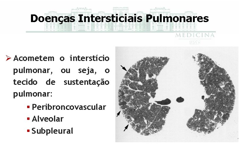 Doenças Intersticiais Pulmonares Ø Acometem o interstício pulmonar, ou seja, o tecido de sustentação