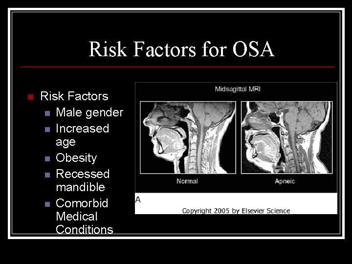 Risk Factors for OSA n Risk Factors n Male gender n Increased age n