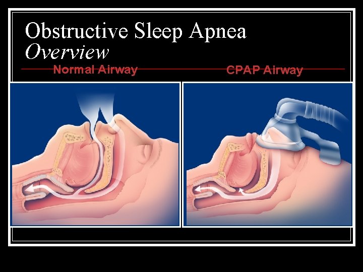 Obstructive Sleep Apnea Overview Normal Airway CPAP Airway 69 