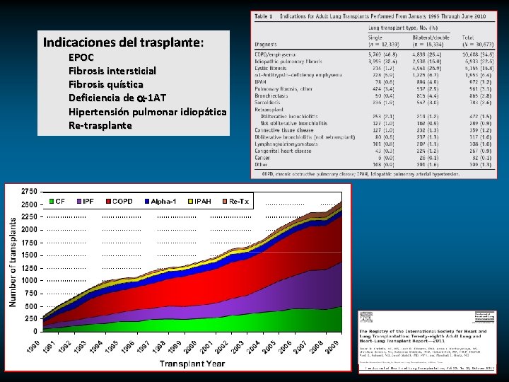 Indicaciones del trasplante: EPOC Fibrosis intersticial Fibrosis quística Deficiencia de a-1 AT Hipertensión pulmonar