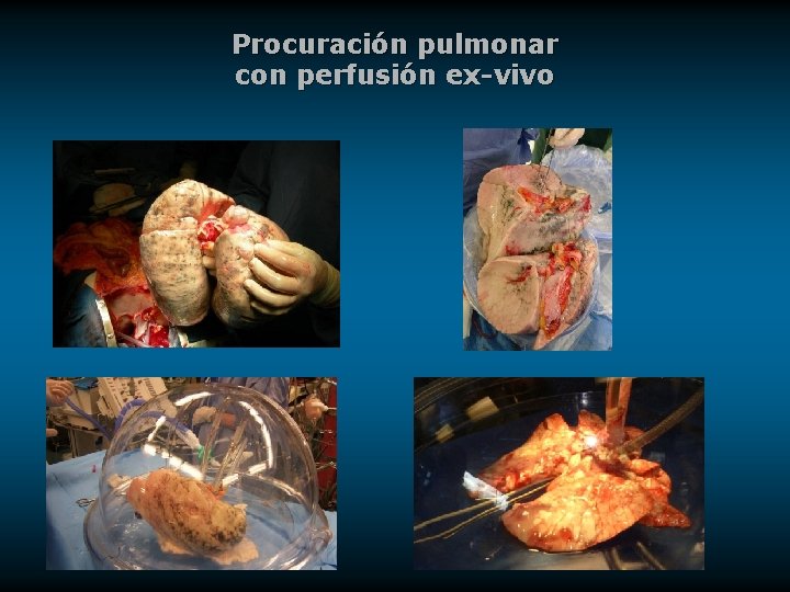 Procuración pulmonar con perfusión ex-vivo 