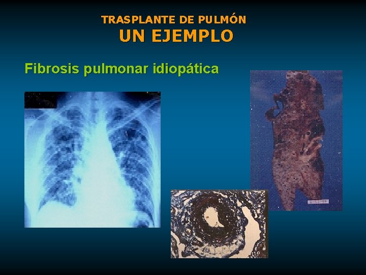 TRASPLANTE DE PULMÓN UN EJEMPLO Fibrosis pulmonar idiopática 