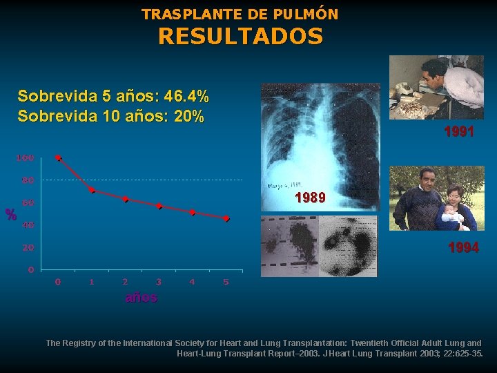 TRASPLANTE DE PULMÓN RESULTADOS Sobrevida 5 años: 46. 4% Sobrevida 10 años: 20% 1991