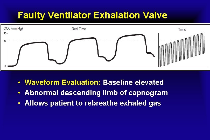 Faulty Ventilator Exhalation Valve • Waveform Evaluation: Baseline elevated • Abnormal descending limb of
