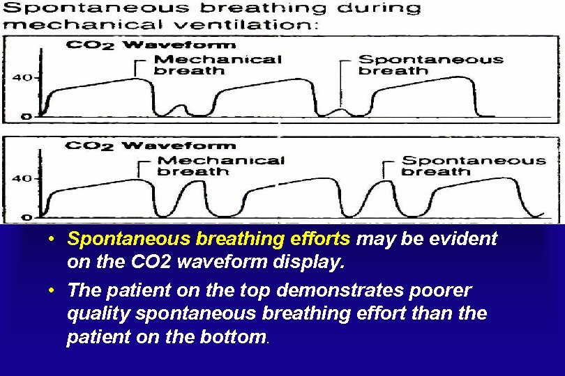  • Spontaneous breathing efforts may be evident on the CO 2 waveform display.