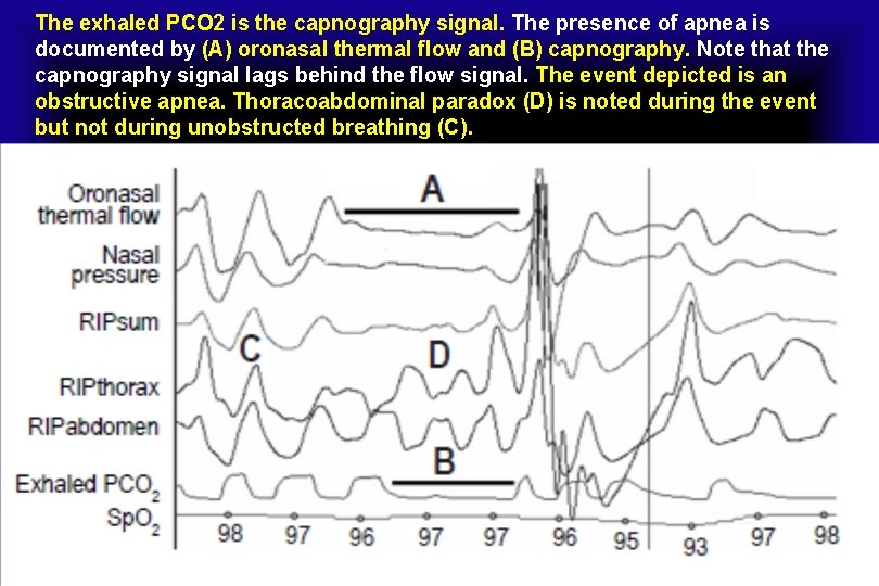 The exhaled PCO 2 is the capnography signal. The presence of apnea is documented