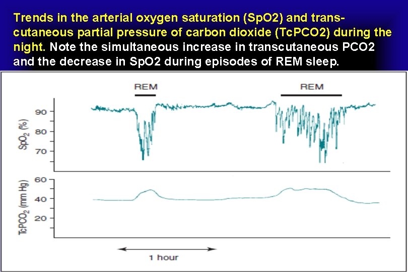 Trends in the arterial oxygen saturation (Sp. O 2) and transcutaneous partial pressure of
