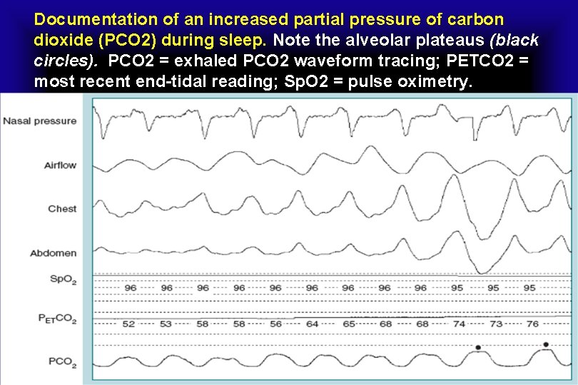 Documentation of an increased partial pressure of carbon dioxide (PCO 2) during sleep. Note