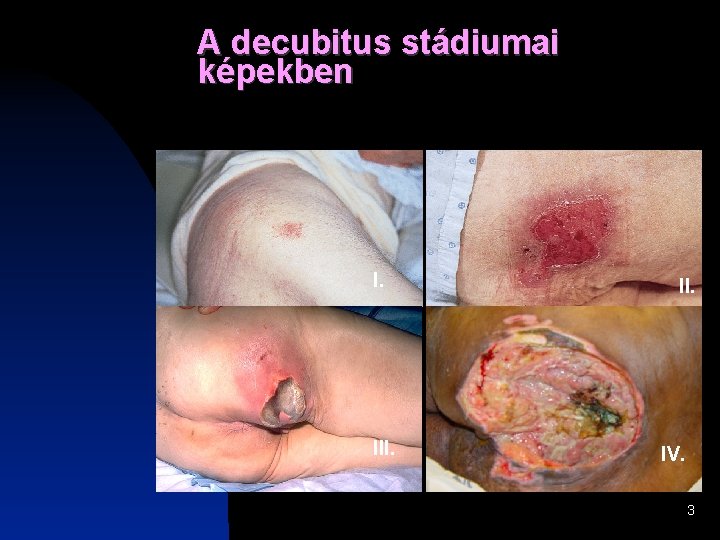 A decubitus stádiumai képekben I. II. IV. 3 A decubitus stádiumai képekben I. II. IV. 3