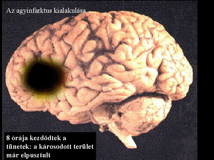 Az agyinfarktus kialakulása 8 órája kezdődtek a tünetek: a károsodott terület már elpusztult 