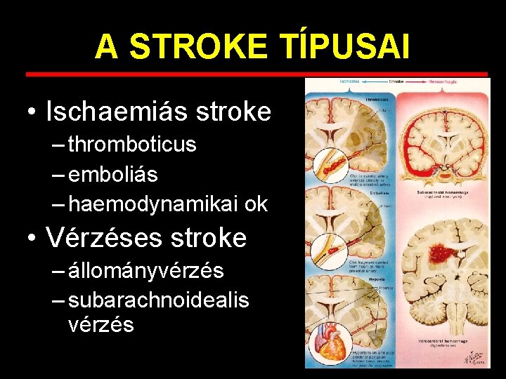 A STROKE TÍPUSAI • Ischaemiás stroke – thromboticus – emboliás – haemodynamikai ok •