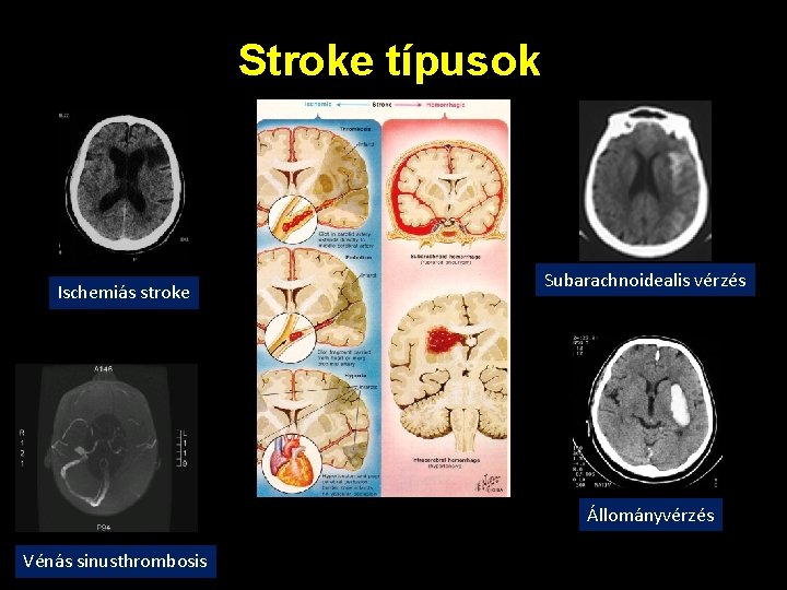 Stroke típusok Ischemiás stroke Subarachnoidealis vérzés Állományvérzés Vénás sinusthrombosis 