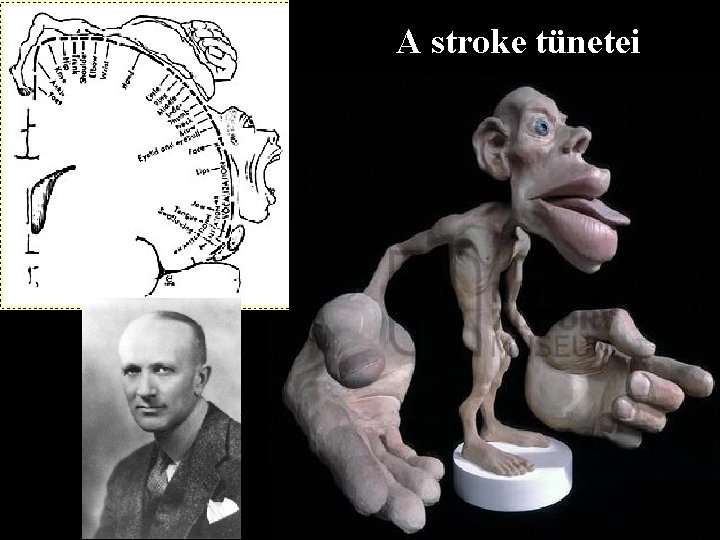 A stroke tünetei 