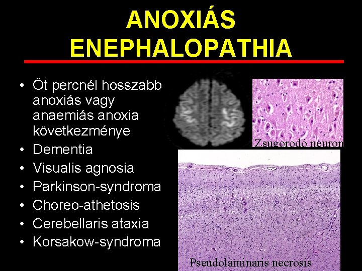 ANOXIÁS ENEPHALOPATHIA • Öt percnél hosszabb anoxiás vagy anaemiás anoxia következménye • Dementia •