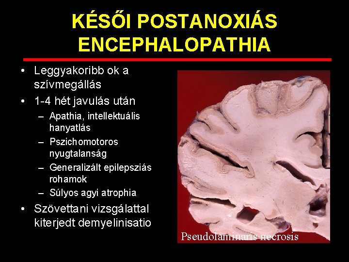 KÉSŐI POSTANOXIÁS ENCEPHALOPATHIA • Leggyakoribb ok a szívmegállás • 1 -4 hét javulás után